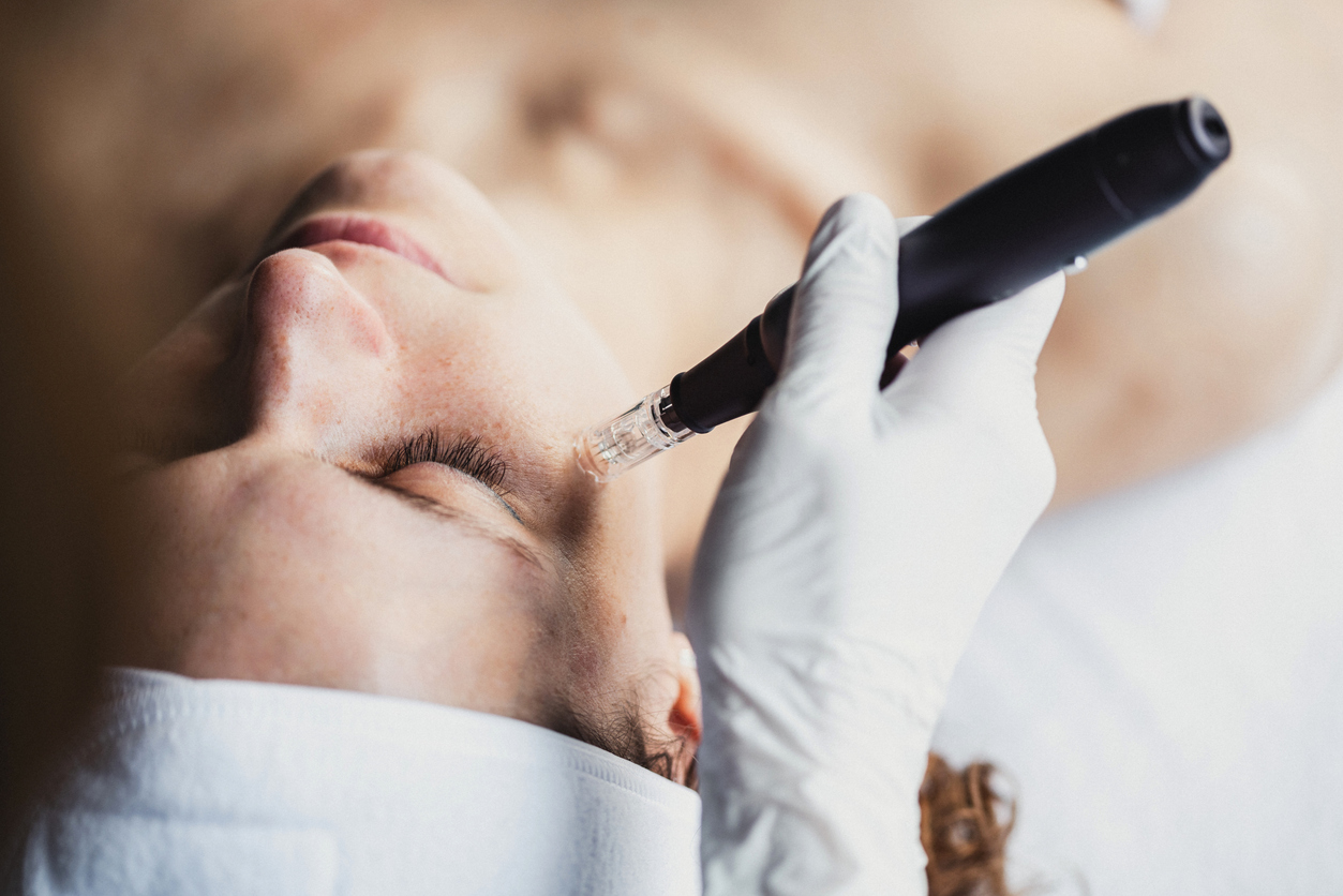 Microneedling-Behandlung im Gesicht mit einem Dermapen