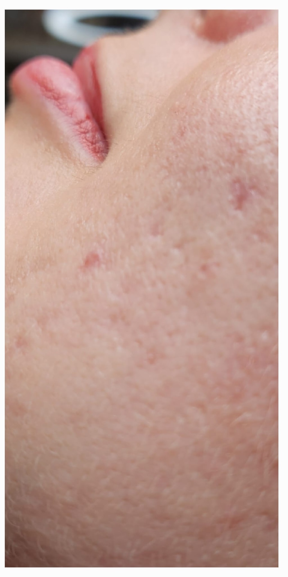 Wange nach einer Microneedling-Behandlung