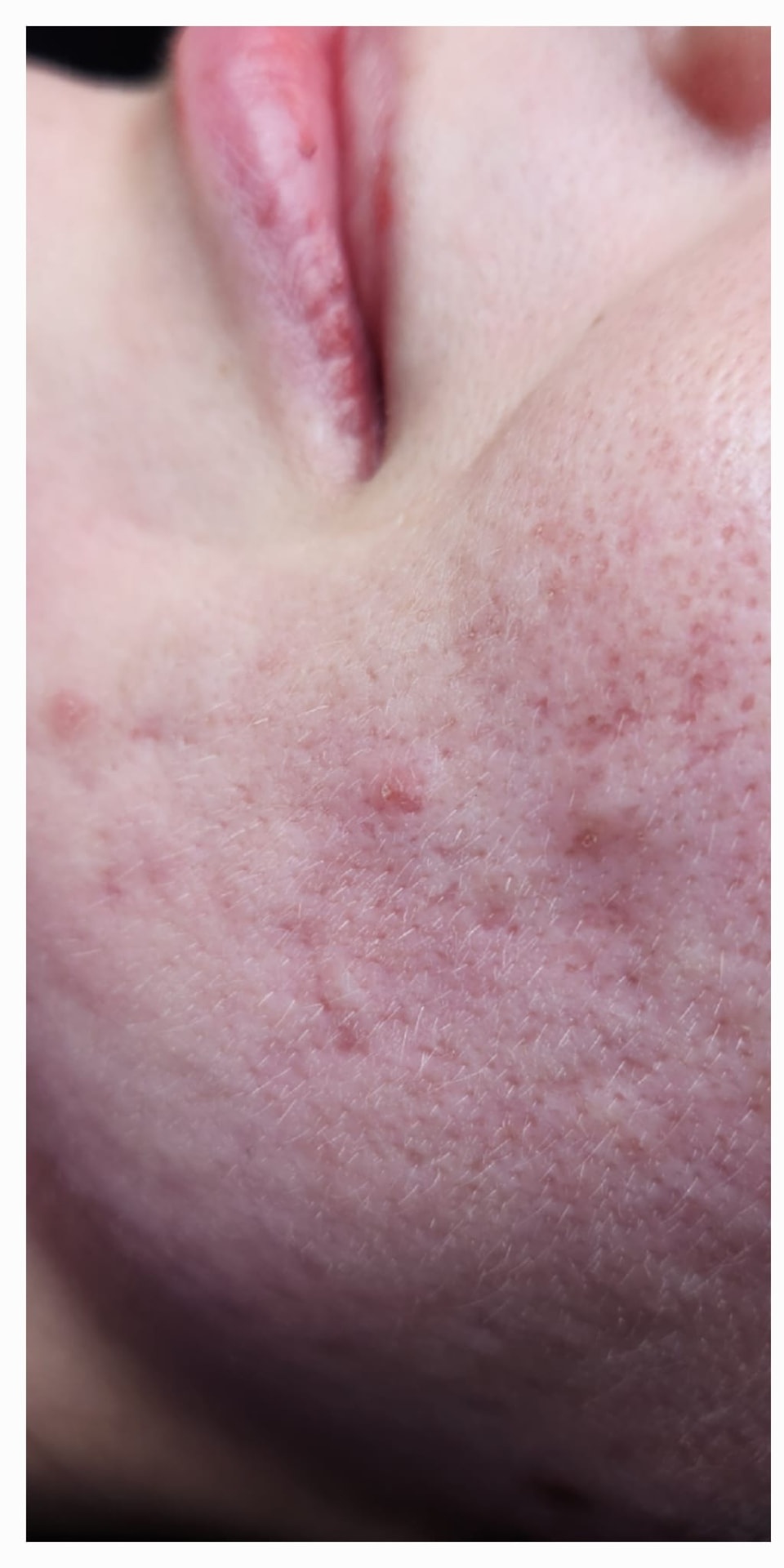 Wange vor einer Microneedling-Behandlung